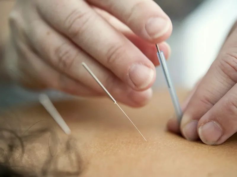 Manos de un terapeuta aplicando agujas finas de acupuntura